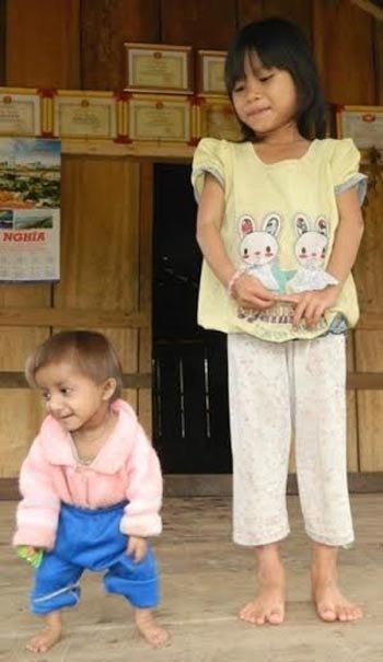 Nhờ chuyên gia y tế tìm nguyên nhân điều trị cho 2 bé “tí hon” - 2 Cùng tuổi nhưng K'rể nhỏ hơn hẳn so với bạn