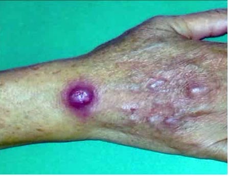 Mỹ: Nhiễm trùng da hiếm gặp từ chợ cá khu người Hoa