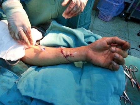 Nối thành công cánh tay bị chém đứt rời - 1 Cánh tay anh Lai được nối lại thành công (ảnh: Do ekip bác
sĩ tại BVĐK Bình Định cung cấp)