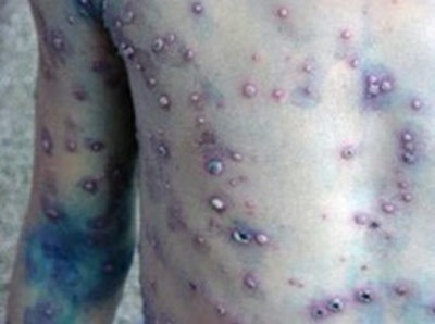 Bệnh thủy đậu hiện nay đã tấn công trẻ em kể cả người lớn (ảnh
internet minh họa)