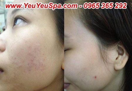 600 khách hàng được trị mụn trứng cá miễn phí  - 1 600 khách hàng được trị mụn trứng cá miễn phí