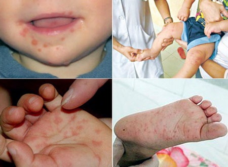 Cảnh báo bệnh tay chân miệng vào mùa - 1 Ảnh minh họa