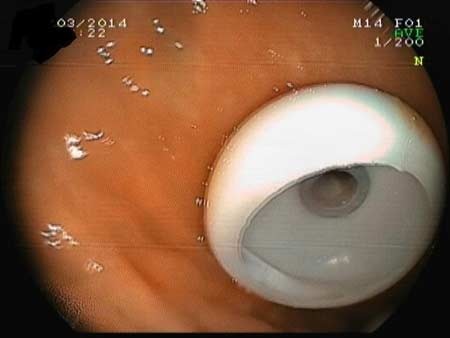 Lần đầu nội soi tạo miệng ăn trên bụng cụ già 95 tuổi