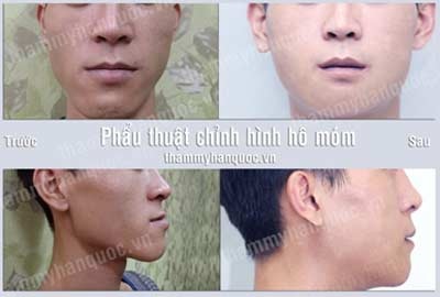 Xem thêm thông tin Phẫu thuật hàm hô