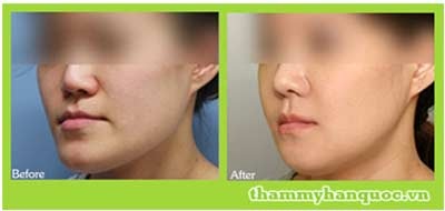 Xem thêm thông tin Phẫu thuật hàm hô