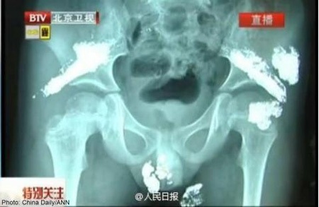 Kết quả chụp X-quang phần hông của bé Yu