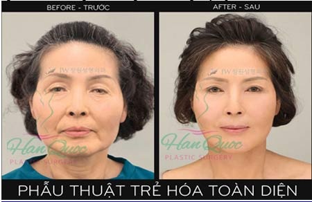Trẻ hóa toàn diện tại Thẩm mỹ Hàn Quốc JW mừng 30/04 &1/05 - 2 Trẻ hóa toàn diện tại Thẩm mỹ Hàn quốc JW