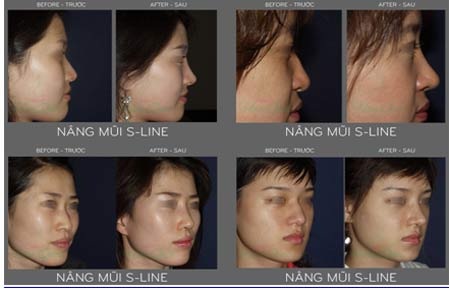 Trẻ hóa toàn diện tại Thẩm mỹ Hàn Quốc JW mừng 30/04 &1/05 - 9 Những hình ảnh Nâng mũi s line tại Thẩm mỹ Hàn Quốc JW năm 2013