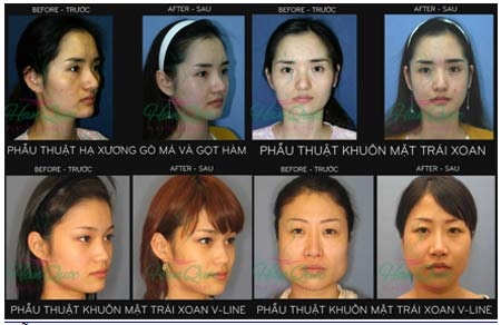 Trẻ hóa toàn diện tại Thẩm mỹ Hàn Quốc JW mừng 30/04 &1/05 - 10 Những hình ảnh Nâng mũi s line tại Thẩm mỹ Hàn Quốc JW năm 2013