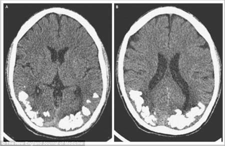 Bị sỏi trong não do dị ứng bánh mì! - 1 Những viên sỏi can xi trong não bệnh nhân