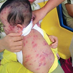Công điện khẩn tăng cường phòng chống bệnh sởi - 1 Công điện khẩn tăng cường phòng chống bệnh sởi