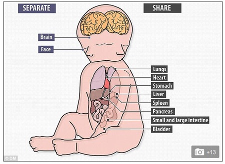 Hai bé ra đời sớm hơn 6 tuần so với dự kiến.
