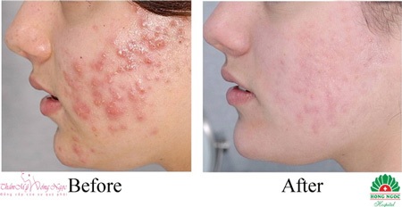 Trị mụn an toàn bằng công nghệ mới Healite tại Thẩm mỹ Hồng Ngọc - 2 Da mặt láng mịn và sạch mụn nhờ công nghệ Healite