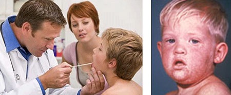 Hoa Kỳ: Cảnh báo người dân không nên chủ quan với sởi! - 1 Một số hình ảnh về sởi ở Hoa Kỳ, 2013-2014