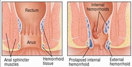 Điều trị bệnh trĩ bằng dược liệu - 1 Dấu hiệu bệnh trĩ