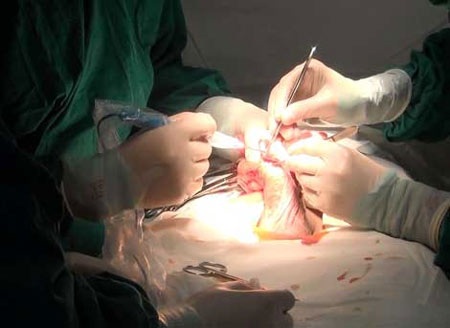Bi hài chuyện đàn ông đi làm đẹp “của quý” - 2 Phẫu thuật nạo hút silicon, cắt mô hoại tử và tạo hình dương vật.