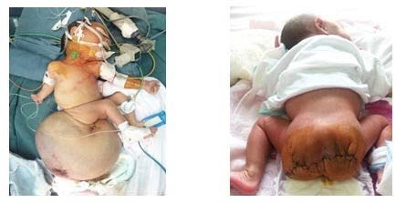 Phẫu thuật thành công khối u 2,6kg cho bé 6 ngày tuổi - 1 Phẫu thuật thành công khối u 2,6kg cho bé 6 ngày tuổi