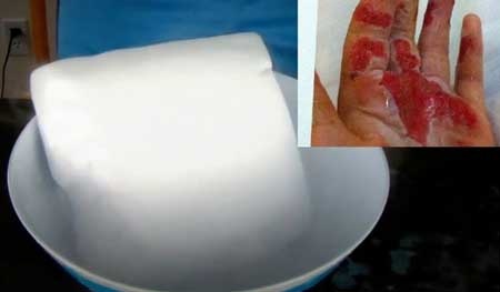 Tổn thương bỏng lòng bàn tay do đá khô. Ảnh: abc.net.au