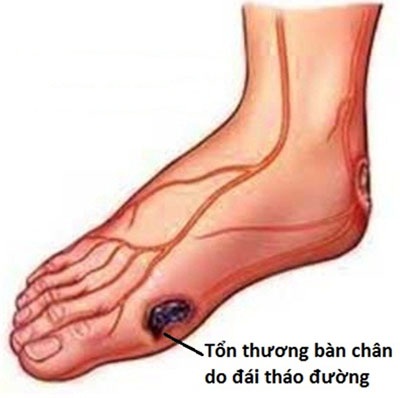 Cắt cụt chi - Nguy cơ cao ở bệnh nhân đái tháo đường - 1 Vì sao hoại tử chi?