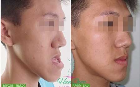 Phẫu thuật ca móm khó 5 năm không khép được miệng - 1 Hình ảnh trước và sau ca Phẫu thuật hàm móm của bạn Khoa