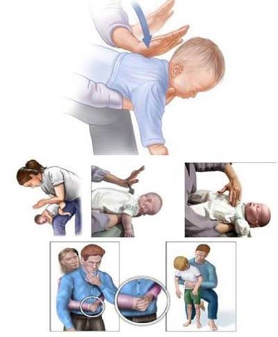 Việc cần làm ngay khi trẻ hóc dị vật - 1 ThS. BS. Lương Quốc Chính