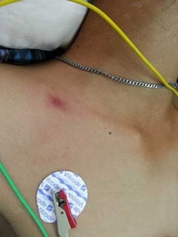 Vết cắn rất nhỏ nhưng đã khiến bệnh nhi nhanh chóng rơi vào tình trạng nguy kịch