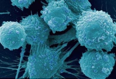 Giảm 60% nguy cơ ung thư tuyến tiền liệt khi cắt bao quy đầu - 1 Tế bào ung thư tuyến tiền liệt