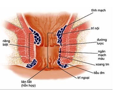 Điều trị bệnh trĩ tận gốc - 1 Điều trị bệnh trĩ tận gốc