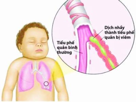 Chớ nhầm thuốc ho với thuốc có tác dụng trên đờm - 1 Cần dùng các thuốc có tác dụng trên đờm một cách hợp lý.