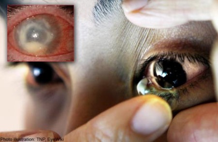 Bị amip “ăn” mắt do mang kính áp tròng suốt 6 tháng - 1 Bị amip “ăn” mắt do mang kính áp tròng suốt 6 tháng