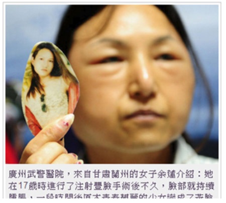 7 lý do để không phẫu thuật thẩm mỹ - 2 Hình ảnh cho thấy miệng độn nâng ngực chạy xuống bụng của Tian