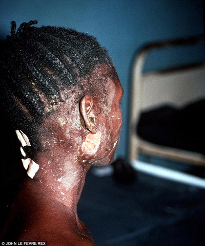 Một bệnh nhân Ebola bị lóc da