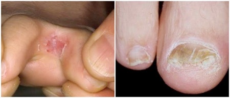 Giày vớ ẩm ướt là điềuĠkiện thuận lợi đế nấm kẽ chân, nấm
móng xâm nhiễm