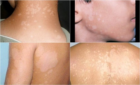 Việc luyện tập ra nhiều mồ hôi khiến nhiều người chơi thể
thao dễ mắc lang ben