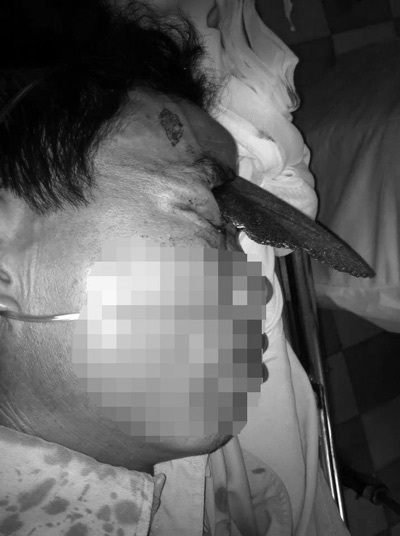 Nạn nhân được chuyển đến cấp cứu với miếng đá dài găm sâu
vào đầu (ảnh do bác sĩ cung cấp)