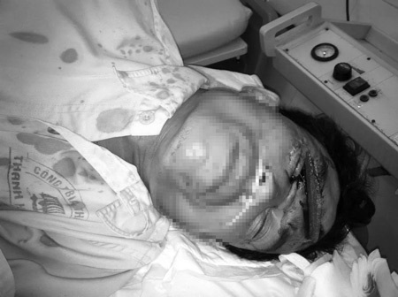 Nạn nhân được chuyển đến cấp cứu với miếng đá dài găm sâu
vào đầu (ảnh do bác sĩ cung cấp)