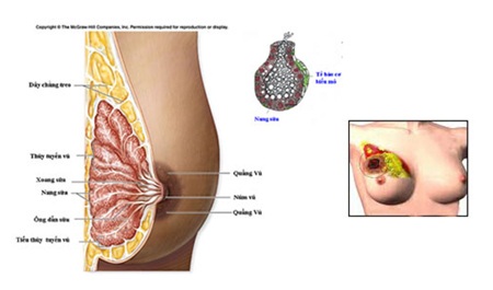 Các giai đoạn phát triển ung thư vú - 1 Các giai đoạn phát triển ung thư vú
