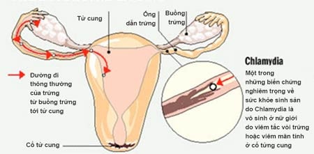 Nhiễm chlamydia: Bệnh dễ chủ quan! - 1 Chlamydia có thể gây vô sinh ở nữ giới