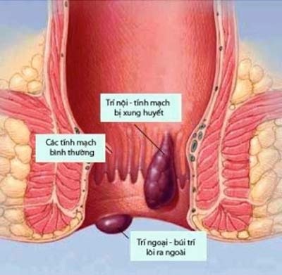 Ám ảnh vì trĩ tái phát sau khi phẫu thuật - 1 Ám ảnh vì trĩ tái phát ɳau khi phẫu thuật