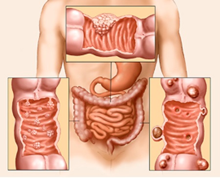 Ngủ quá nhiều làm tăng nguy cơ mắc ung thư đại tràng - 2 Ung thư đại
tràng.