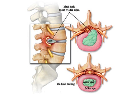 Thoát vị đĩa đệm: Để không phải phẫu thuật…! - 1 Hình minh họa thoát vị đĩa đệm