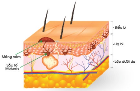 Sắc tố melanin bị tổng hợp quá mức gây ra nám, sạm da