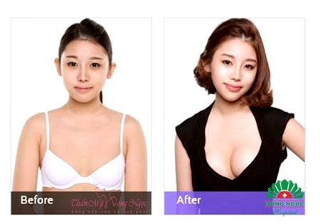 Kết
quả sau khi phẫu thuật nâng ngực nội soi