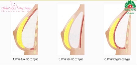 Vị
trí đặt túi độn ngực