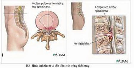 Thoát vị đĩa đệm thường gây đau thần kinh tọa.