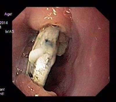 Mổ lấy cục pin nằm trong thực quản bé trai 2 tuổi - 1 Cục pin nằm trong thực quản đã hoen rỉ. Ảnh do bệnh viện cung cấp.