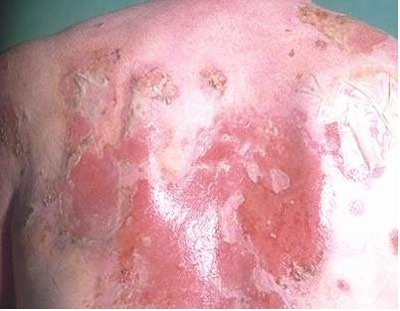 Vẩy nến toàn thân và cách điều trị - 1 Bệnh nhân bị vẩy nến