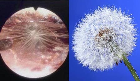 Những đồ vật “kỳ dị” được lấy ra từ cơ thể người - 1 Hoa bồ công anh