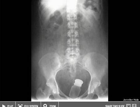 Những đồ vật “kỳ dị” được lấy ra từ cơ thể người - 12 Chai nhựa