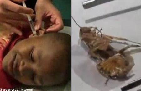 Những đồ vật “kỳ dị” được lấy ra từ cơ thể người - 3 Gián